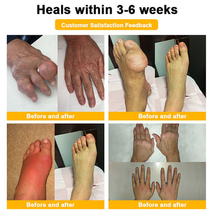 𝗙𝗗𝗔 𝗖𝗲𝗿𝘁𝗶𝗳𝗶𝗲𝗱 · 𝗢𝗳𝗳𝗶𝗰𝗶𝗮𝗹 𝗦𝘁𝗼𝗿𝗲 | Purelora®🔥 BEE VENOM LITHOSPERMUM Pain-Relief Bone Healing Cream 👑👑(Specially for older adults)