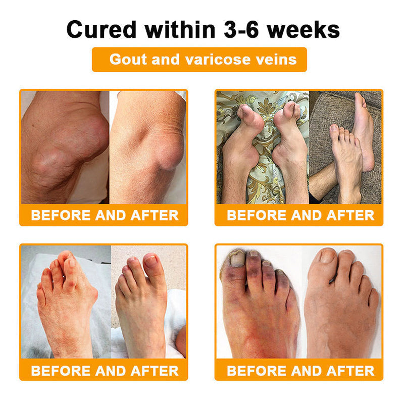 𝗙𝗗𝗔 𝗖𝗲𝗿𝘁𝗶𝗳𝗶𝗲𝗱 · 𝗢𝗳𝗳𝗶𝗰𝗶𝗮𝗹 𝗦𝘁𝗼𝗿𝗲 | Purelora®🔥 BEE VENOM LITHOSPERMUM Pain-Relief Bone Healing Cream 👑👑(Specially for older adults)